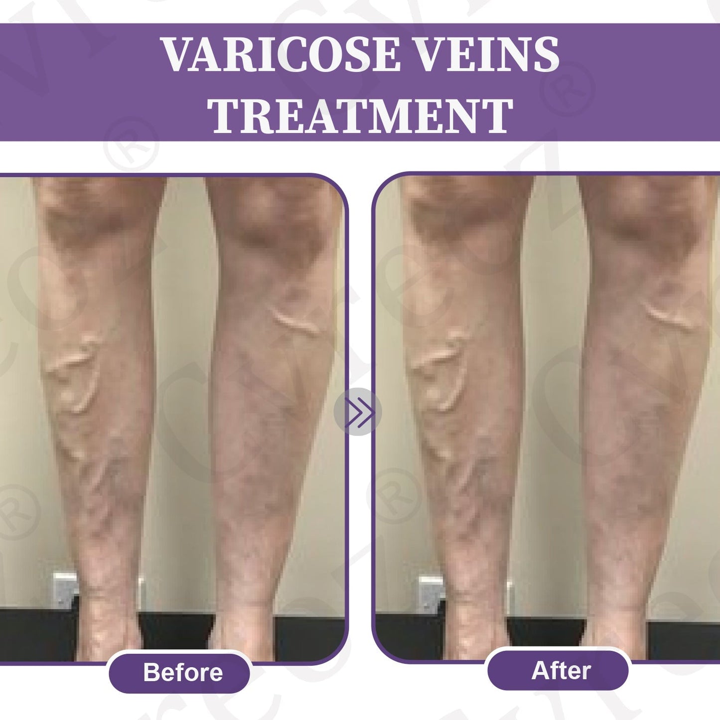 šLOVILDSā¢ā
Care Phyto Cream-HelpsTreat Varicose Veins,Swelling,cramps, andLeg Pain