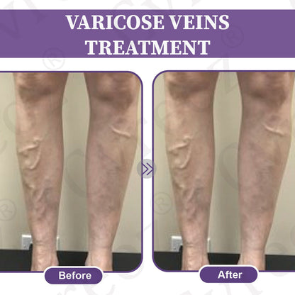 🚀LOVILDS™✅Care Phyto Cream-HelpsTreat Varicose Veins,Swelling,cramps, andLeg Pain