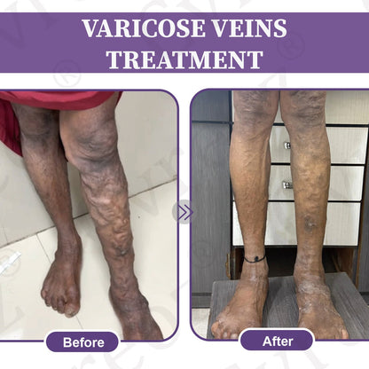 🚀LOVILDS™✅Care Phyto Cream-HelpsTreat Varicose Veins,Swelling,cramps, andLeg Pain