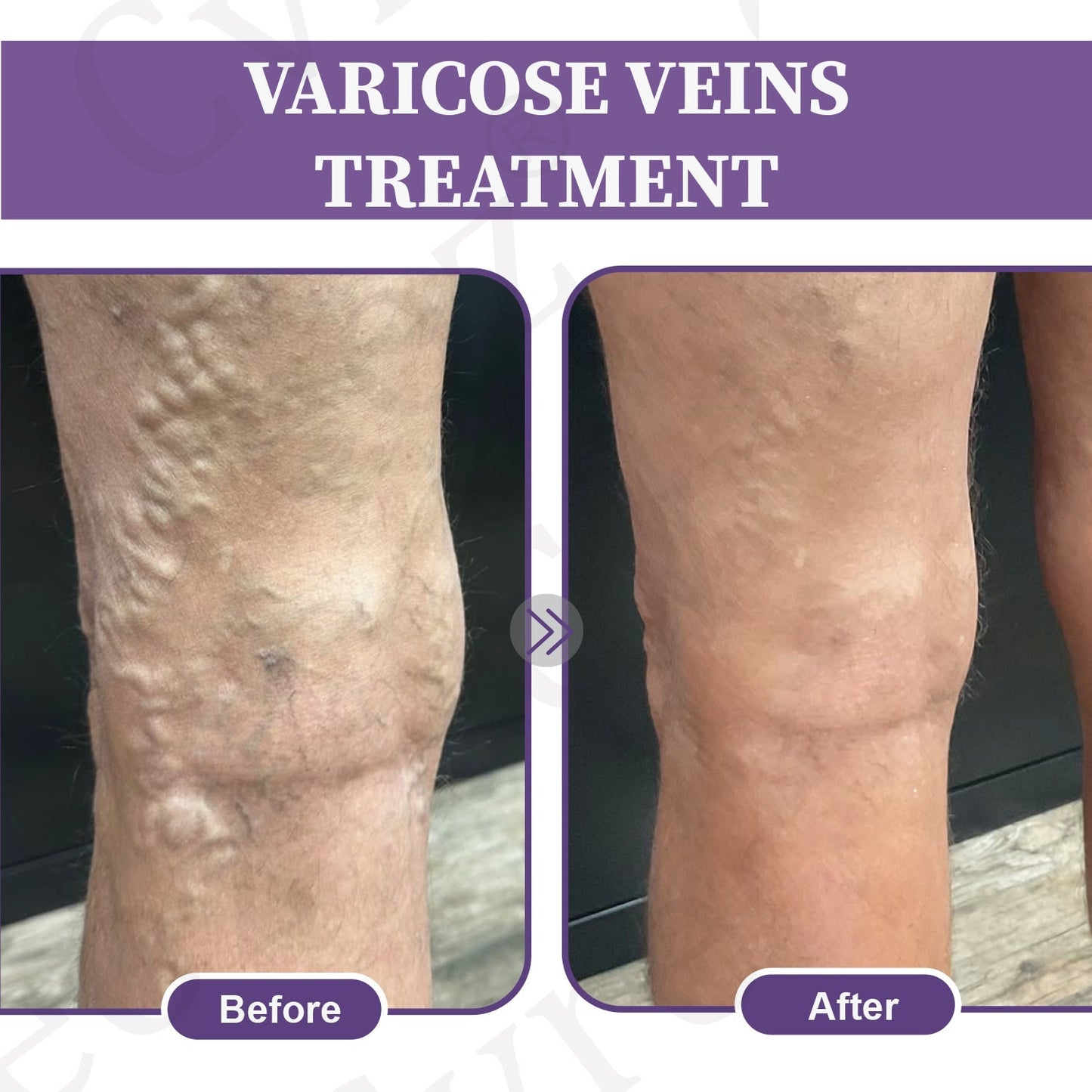 🚀LOVILDS™✅Care Phyto Cream-HelpsTreat Varicose Veins,Swelling,cramps, andLeg Pain